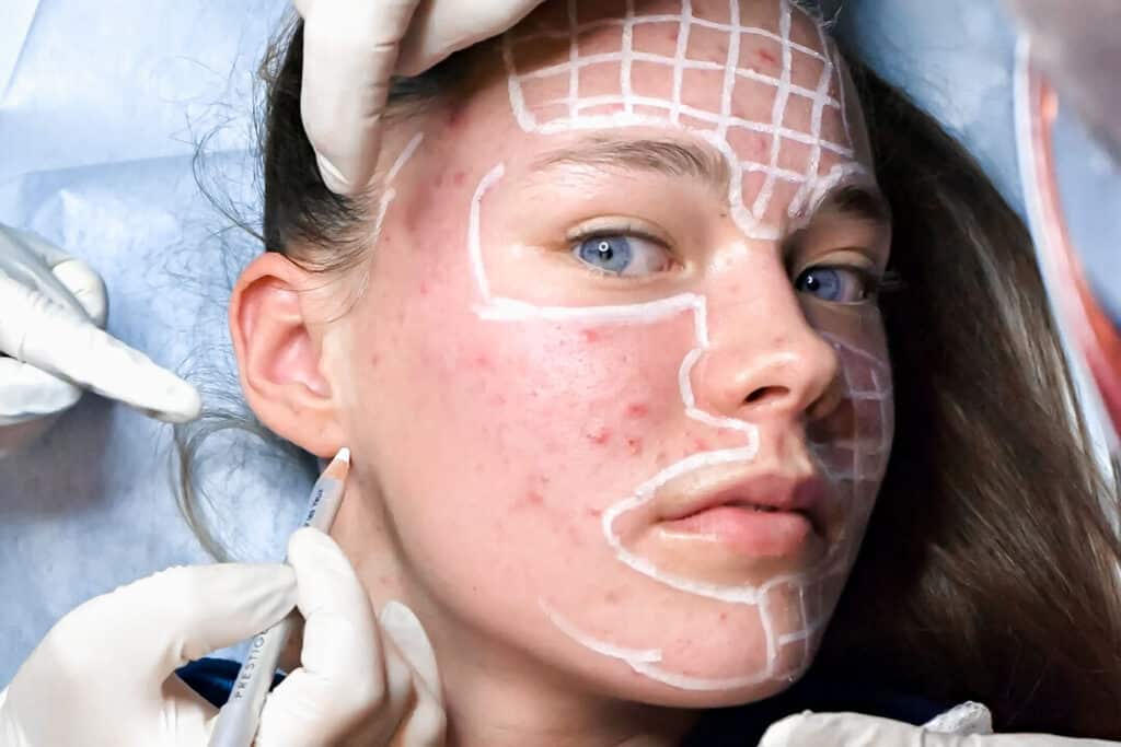 A close up of a patient with a doctor administering treatment for Botox and acne