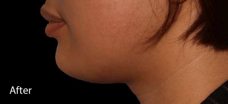 Dermal Fillers Chin After Treatment