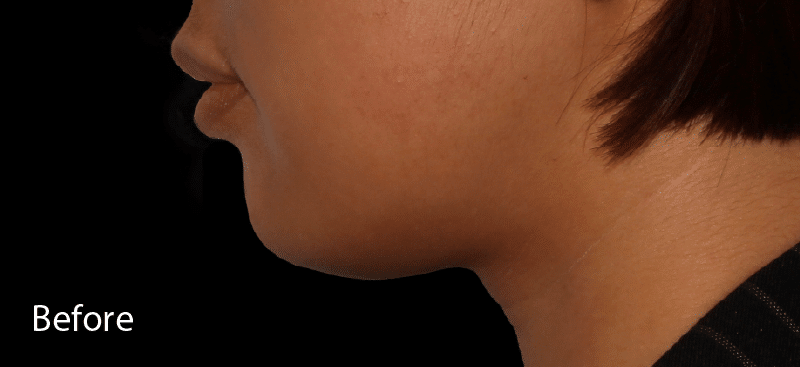 Dermal Fillers Chin Before Treatment