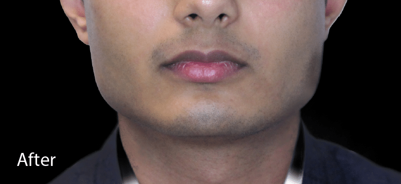 Dermal Fillers Jaw After Treatment