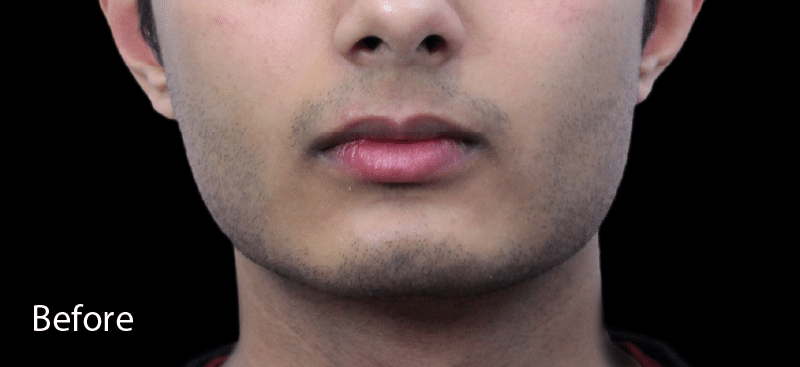 Dermal Fillers Jaw Before Treatment