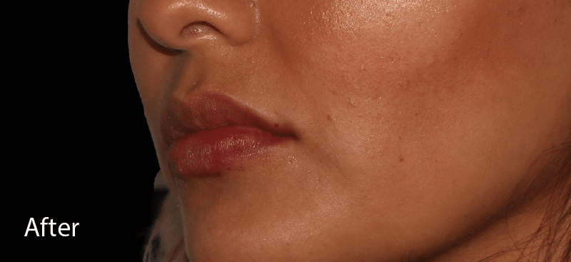 Dermal Fillers Lips After Treatment