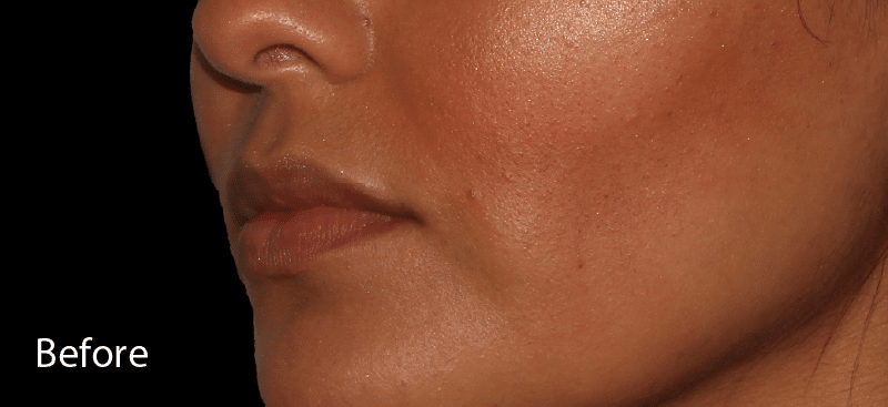 Dermal Fillers Lips Before Treatment