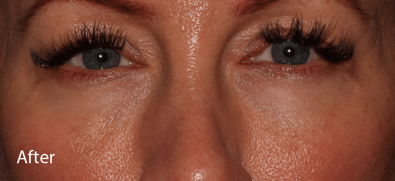 Dermal Fillers Under Eye After Treatment
