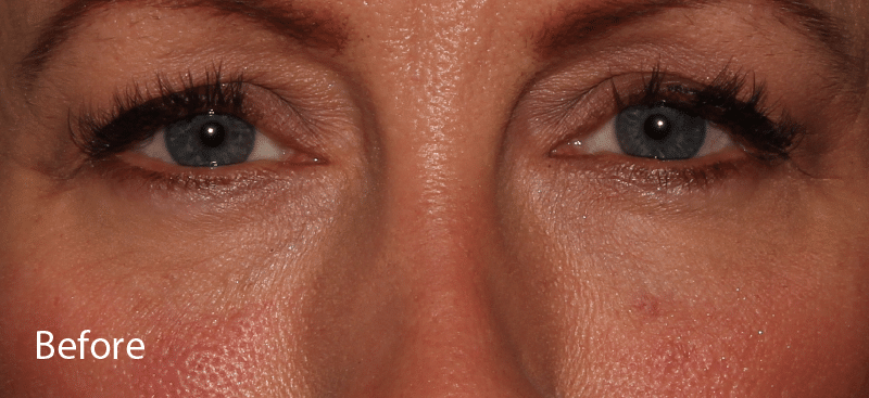 Dermal Fillers Under Eye Before Treatment