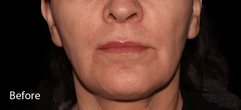 Skin Boosters Before Treatment