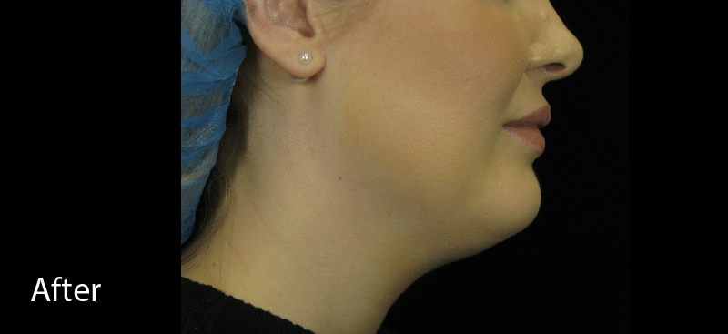 Belkyra Double Chin After Treatment