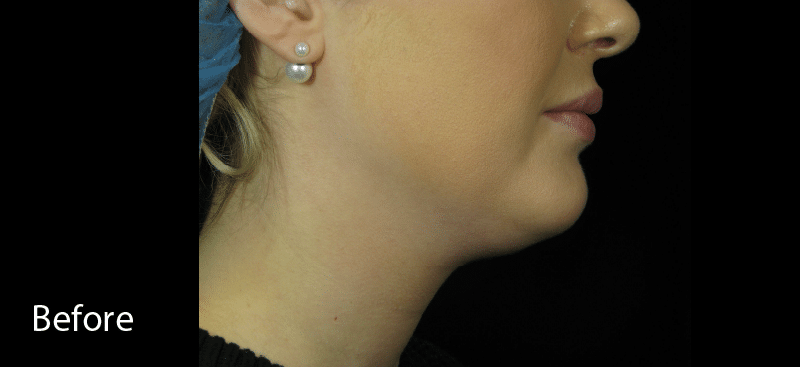 Belkyra Double Chin Before Treatment