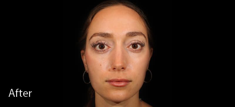 Chemical Peels After Treatment