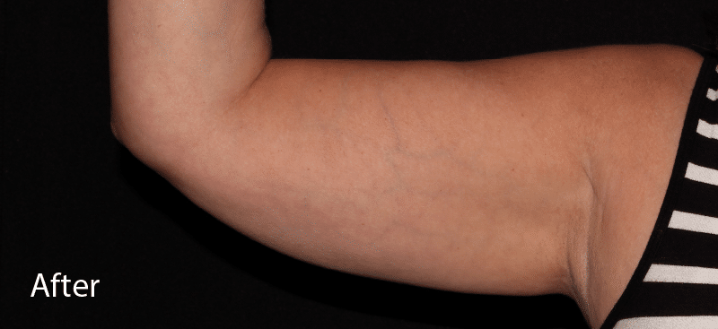 Coolsculpting Arms After Treatment