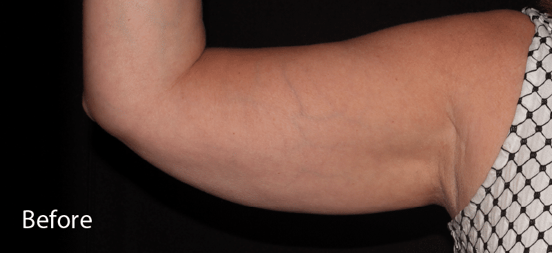 Coolsculpting Arms Before Treatment