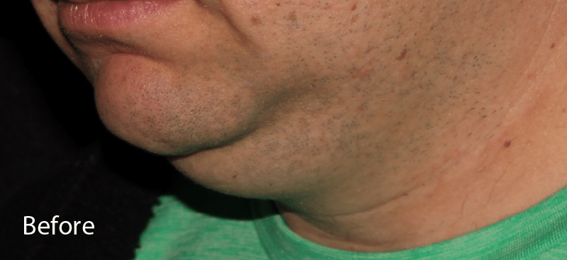 Coolsculpting Double Chin Before Treatment