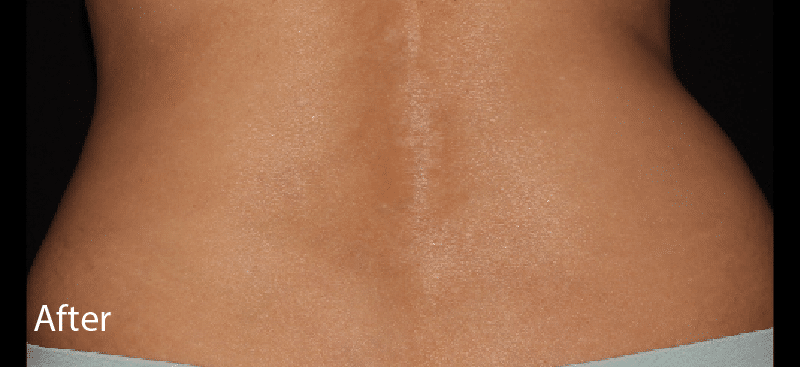 Coolsculpting Flanks After Treatment