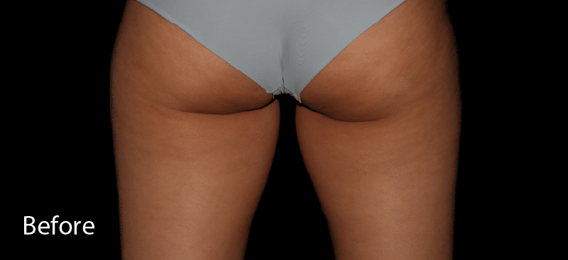 Coolsculpting Inner Thighs Before Treatment