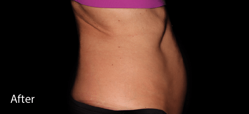 Coolsculpting Lower Abdomen After Treatment
