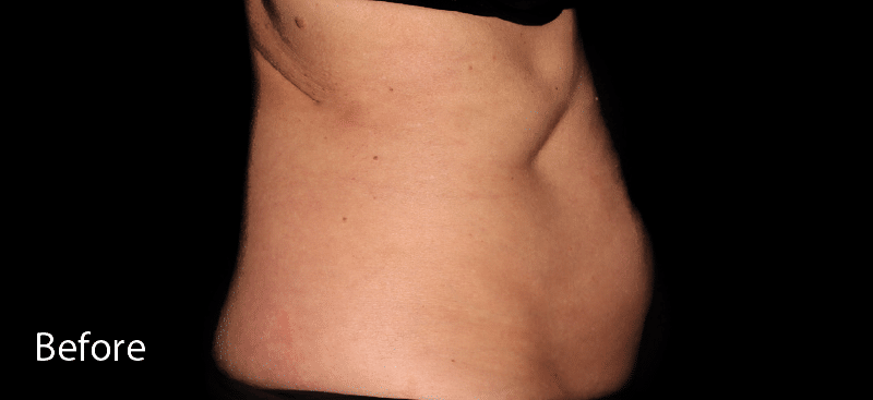 Coolsculpting Lower Abdomen Before Treatment