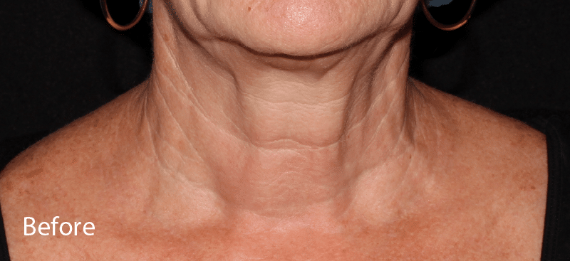 Thermage Sagging Neck Skin Before Treatment