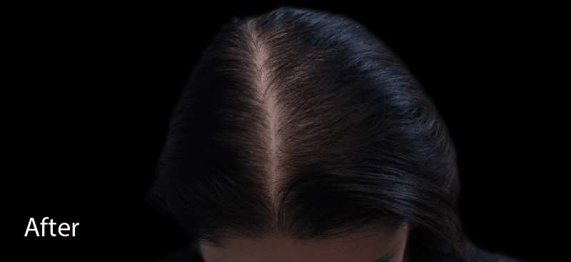PRP Hair Growth Treatment - After