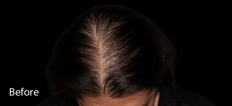 PRP Hair Growth Treatment - Before